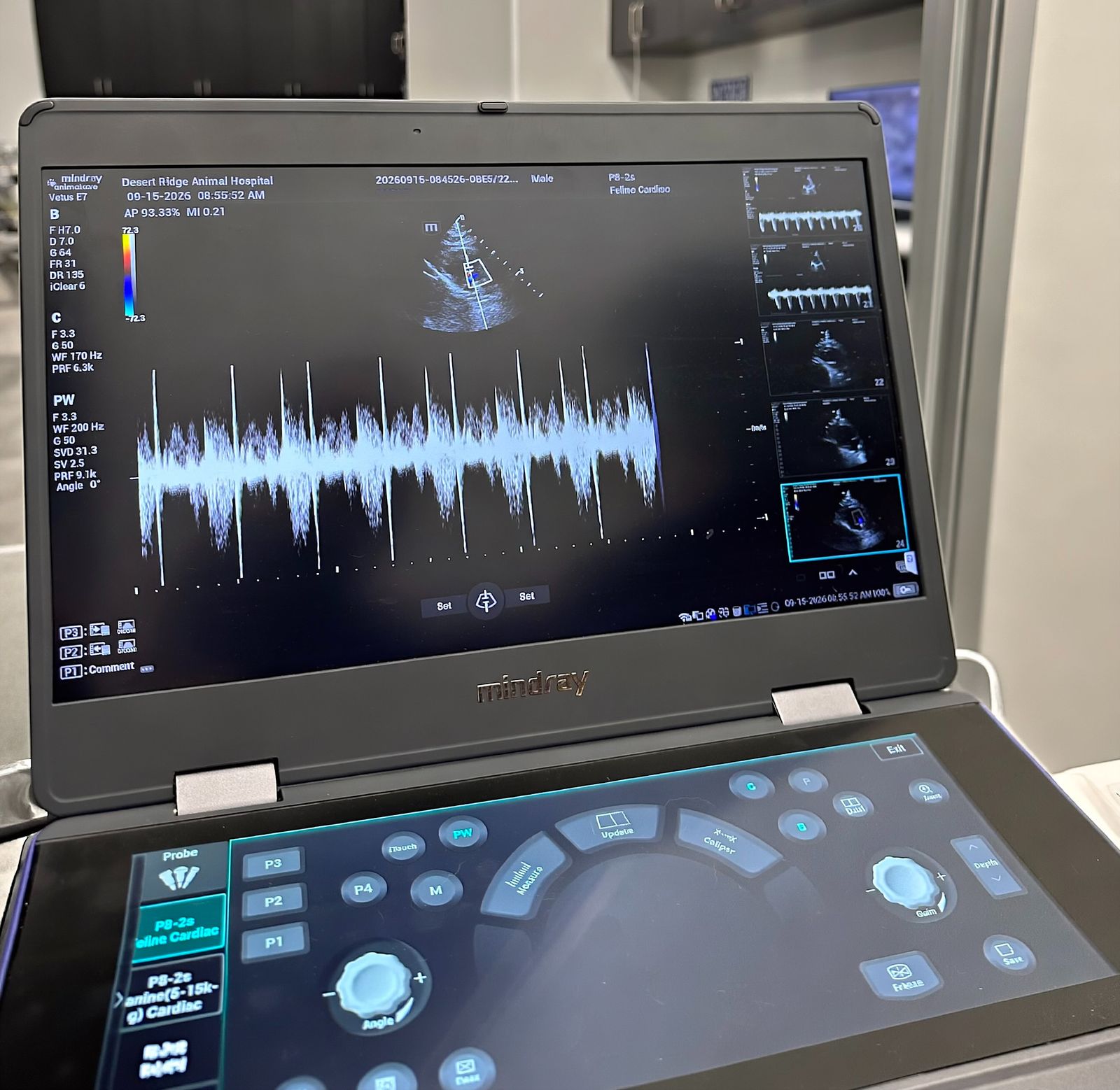 A cardiac ultrasound in progress, showing a two-dimensional view of the heart above a Doppler trace of the blood flowing through it